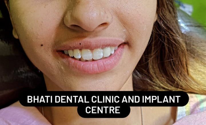 After smile design treatment at Bhati Dental Clinic